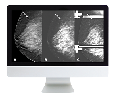 Breast Imaging: Screening and Diagnosis Online Course